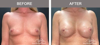 Breast Augmentation Before & After Gallery - Patient 240974 - Image 1