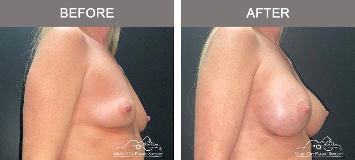 Breast Augmentation Before & After Gallery - Patient 240974 - Image 2