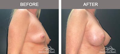 Breast Augmentation Before & After Gallery - Patient 240974 - Image 2