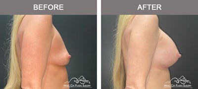 Breast Augmentation Before & After Gallery - Patient 240974 - Image 3