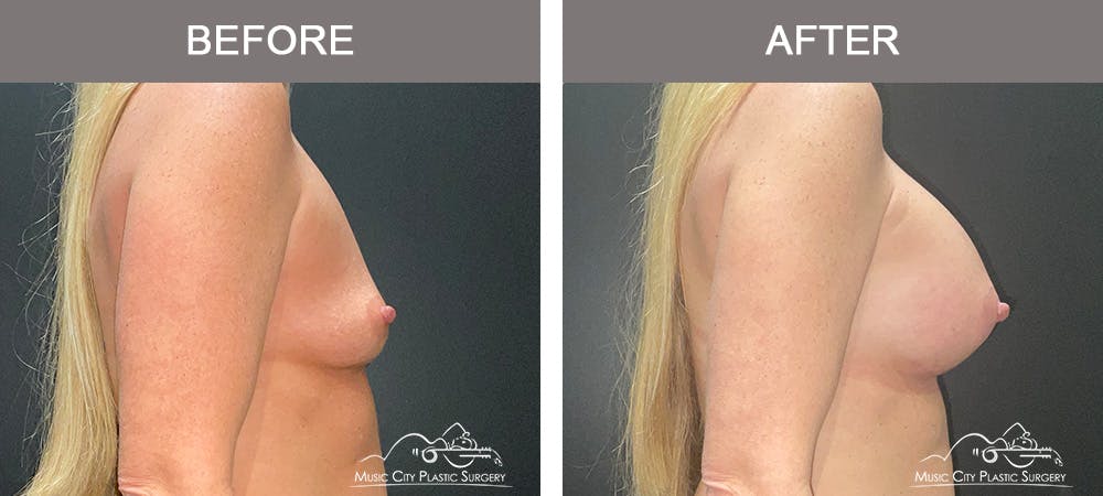 Breast Augmentation Before & After Gallery - Patient 240974 - Image 3