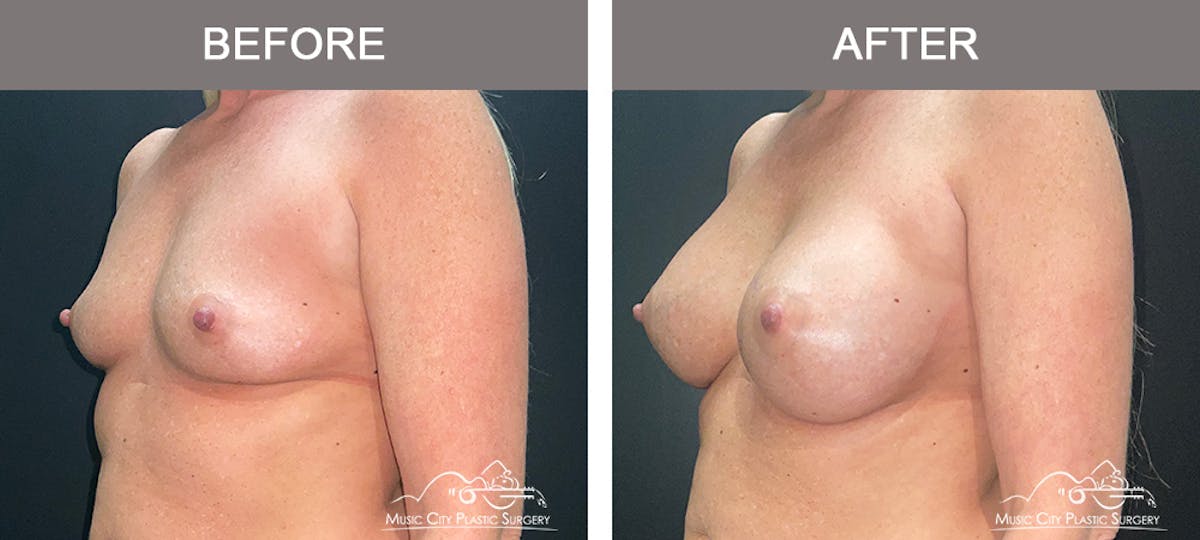 Breast Augmentation Before & After Gallery - Patient 240974 - Image 4