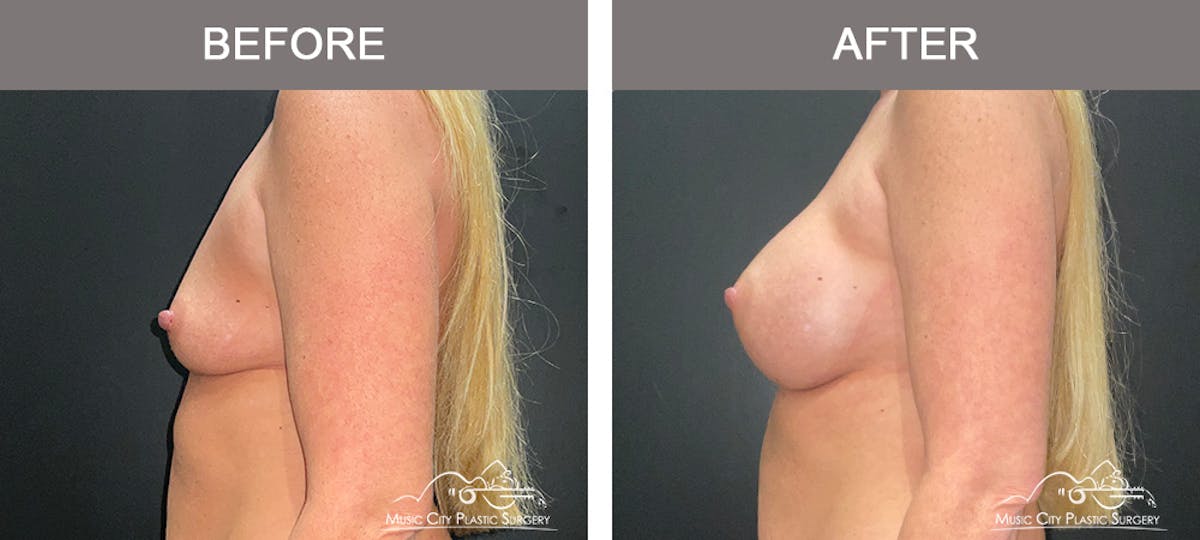 Breast Augmentation Before & After Gallery - Patient 240974 - Image 5