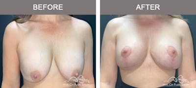 Breast Lift Before & After Gallery - Patient 359992 - Image 1