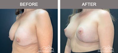 Breast Lift Before & After Gallery - Patient 359992 - Image 2