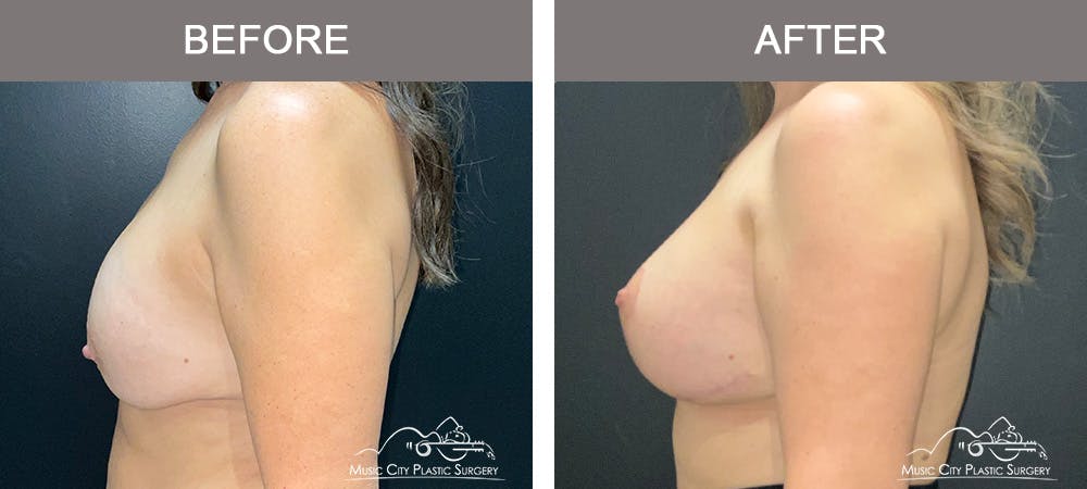 Breast Lift Before & After Gallery - Patient 359992 - Image 3