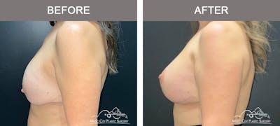 Breast Lift Before & After Gallery - Patient 359992 - Image 3