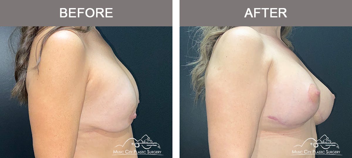 Implant Exchange Before & After Gallery - Patient 192554 - Image 4