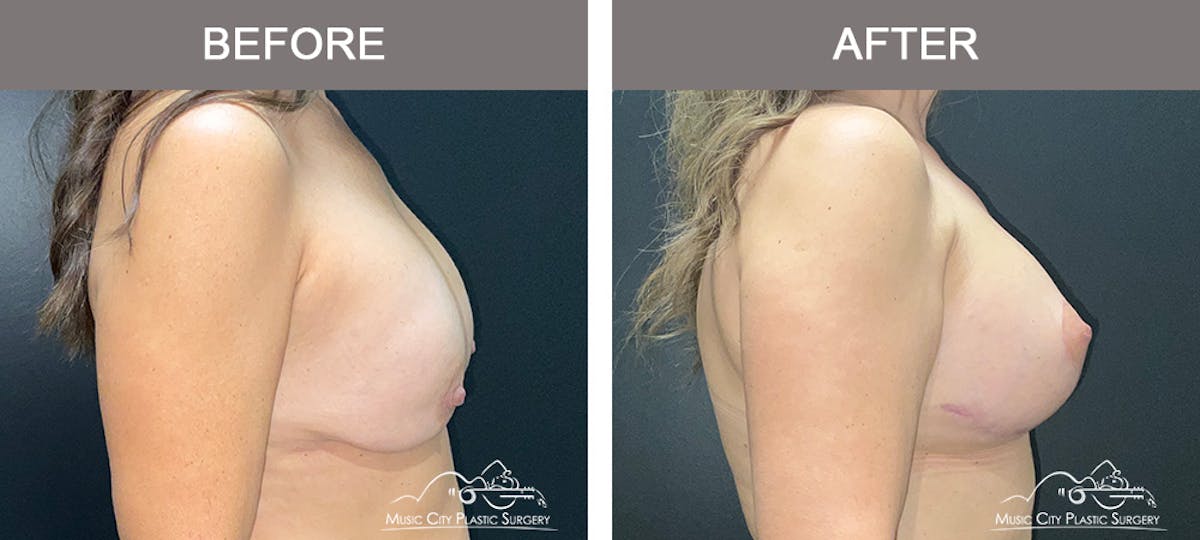 Implant Exchange Before & After Gallery - Patient 192554 - Image 5