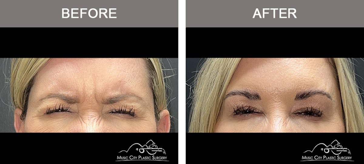 Dysport or Botox Before & After Gallery - Patient 407870 - Image 1