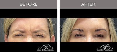 Dysport or Botox Before & After Gallery - Patient 407870 - Image 1