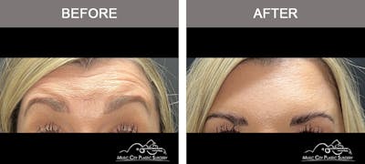 Dysport or Botox Before & After Gallery - Patient 407870 - Image 2