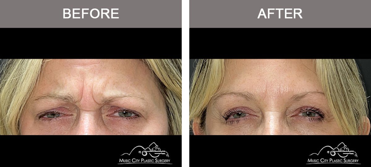 Dysport or Botox Before & After Gallery - Patient 154520 - Image 1