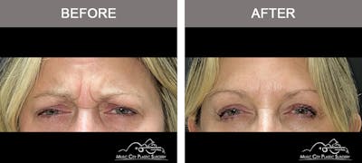 Dysport or Botox Before & After Gallery - Patient 154520 - Image 1