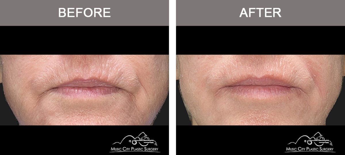 Dermal Fillers Before & After Gallery - Patient 314554 - Image 1