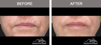Halo Laser Before & After Gallery - Patient 186230 - Image 1