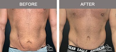 BodyLift Before & After Gallery - Patient 214923 - Image 1