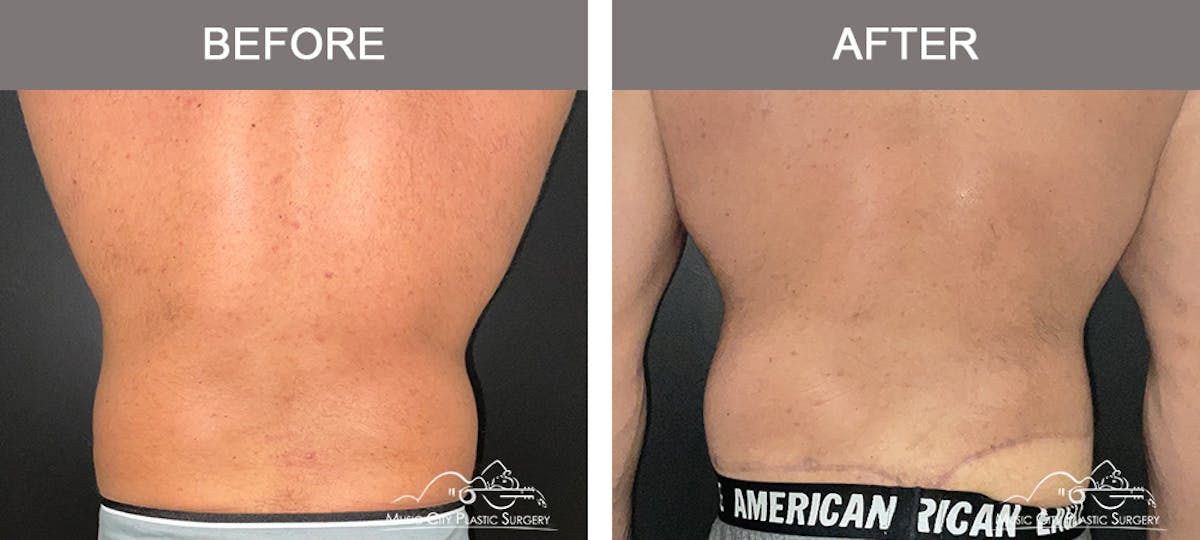 BodyLift Before & After Gallery - Patient 214923 - Image 2
