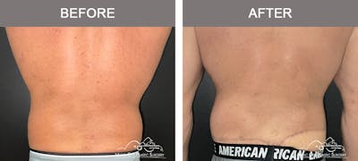 BodyLift Before & After Gallery - Patient 214923 - Image 2