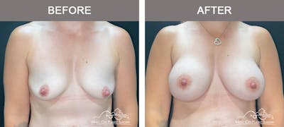Breast Augmentation Before & After Gallery - Patient 300000 - Image 1
