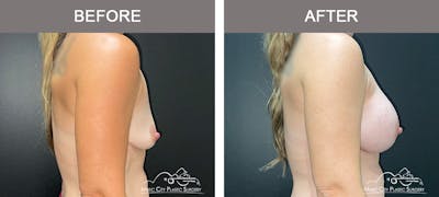 Breast Augmentation Before & After Gallery - Patient 300000 - Image 3