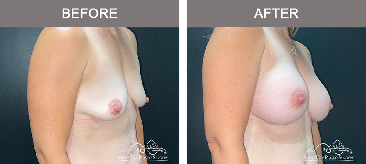 Breast Augmentation Before & After Gallery - Patient 300000 - Image 2