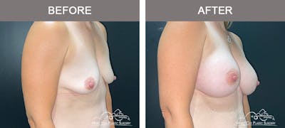 Breast Augmentation Before & After Gallery - Patient 300000 - Image 2