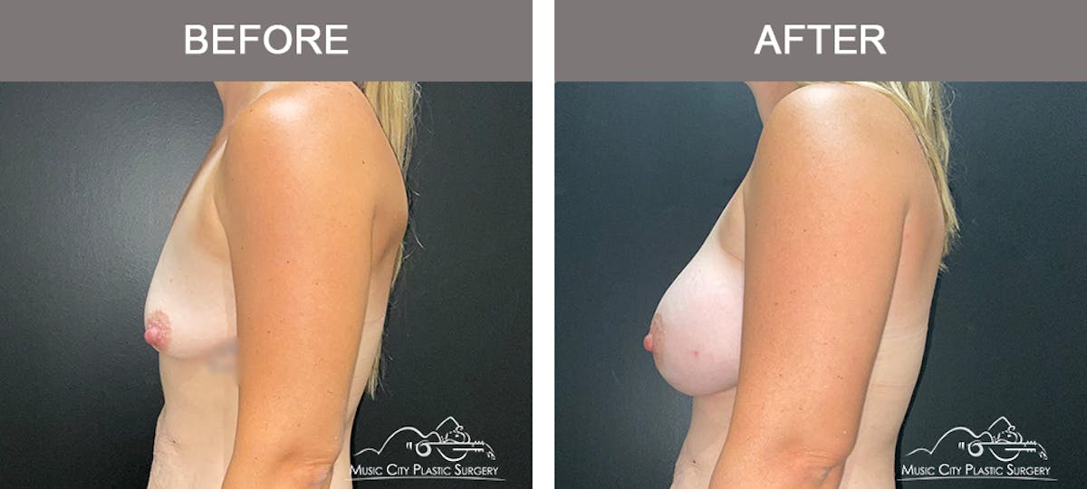 Breast Augmentation Before & After Gallery - Patient 300000 - Image 5