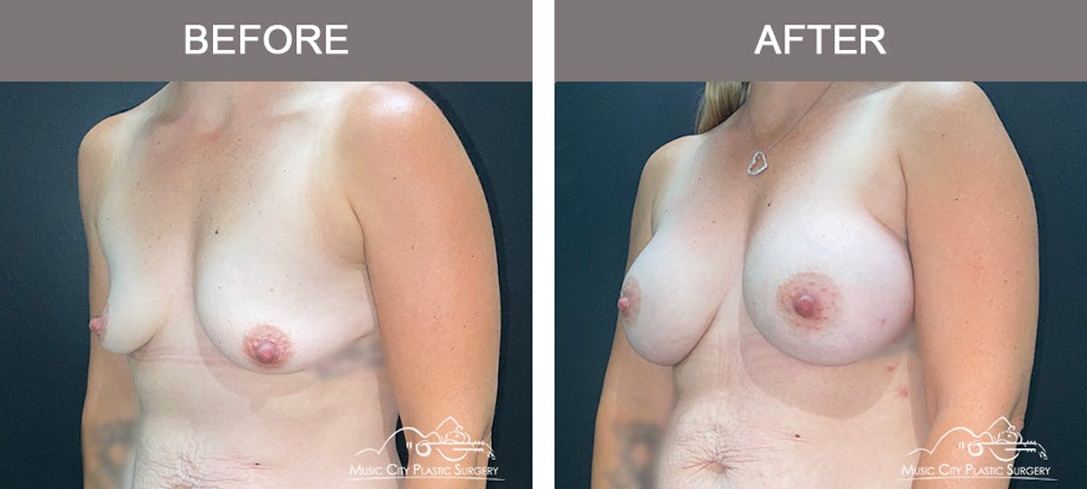 Breast Augmentation Before & After Gallery - Patient 300000 - Image 4