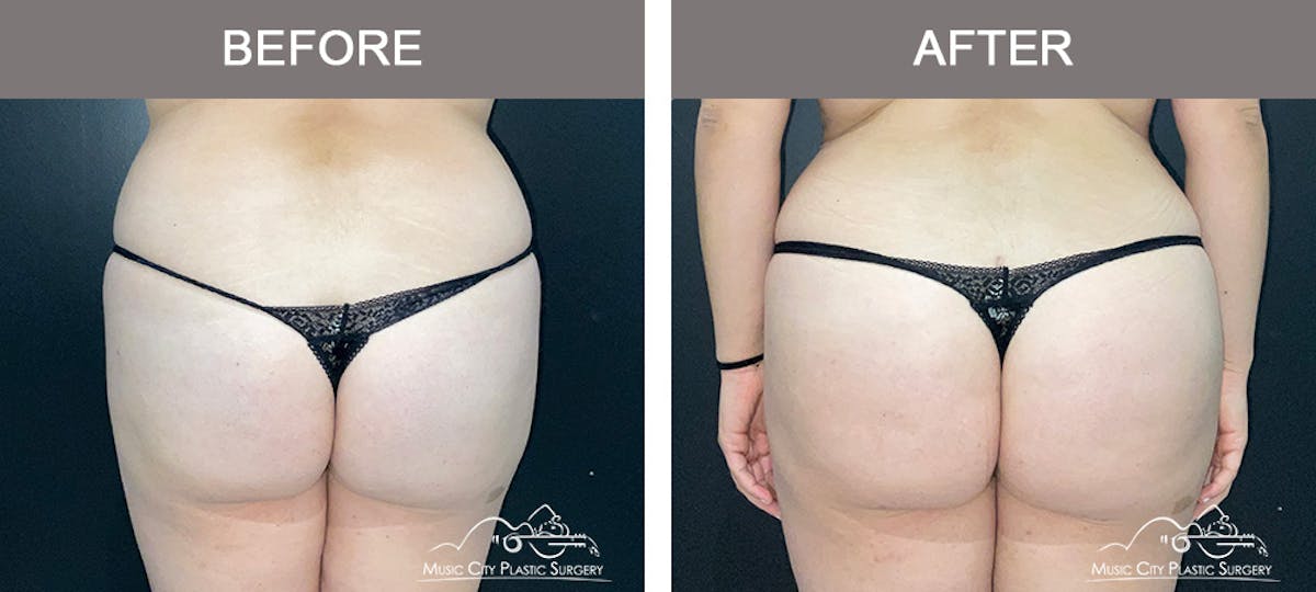 Brazilian Butt Lift Before & After Gallery - Patient 144527 - Image 1
