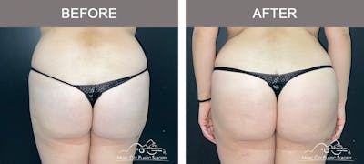 Brazilian Butt Lift Before & After Gallery - Patient 144527 - Image 1