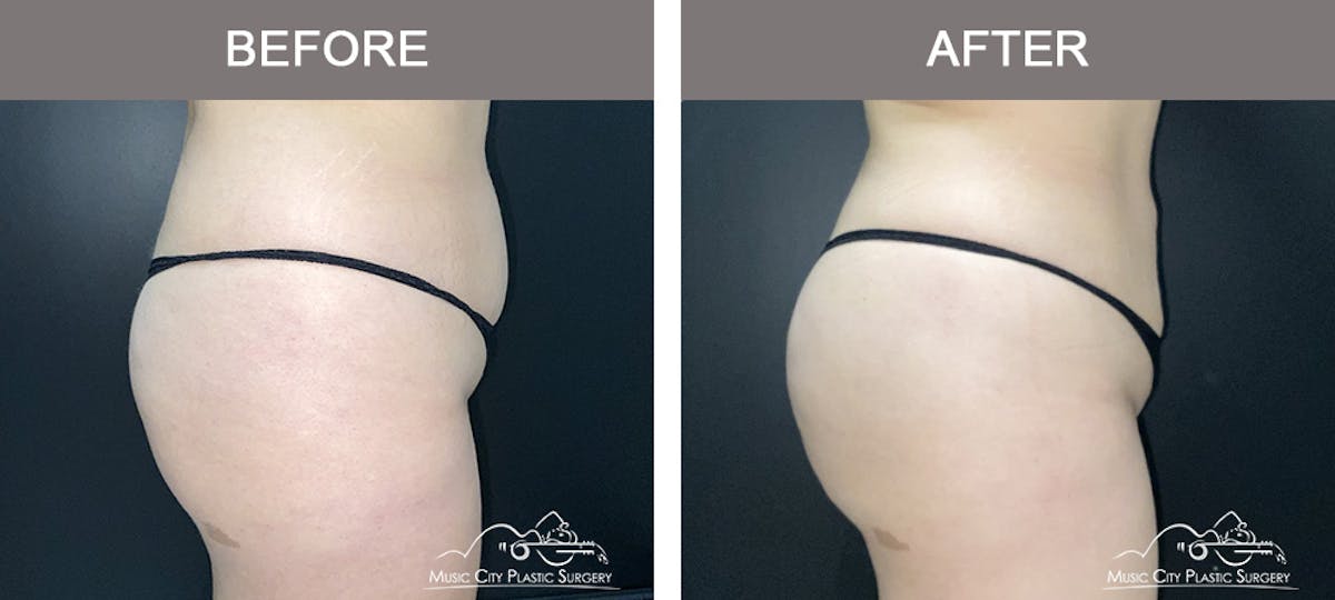 Brazilian Butt Lift Before & After Gallery - Patient 144527 - Image 3