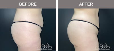 Brazilian Butt Lift Before & After Gallery - Patient 144527 - Image 3