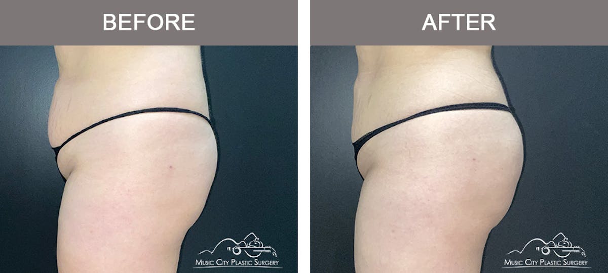Brazilian Butt Lift Before & After Gallery - Patient 144527 - Image 2