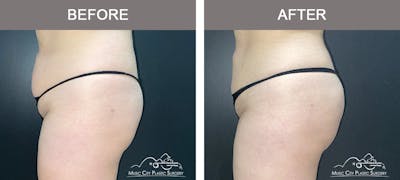Brazilian Butt Lift Before & After Gallery - Patient 144527 - Image 2