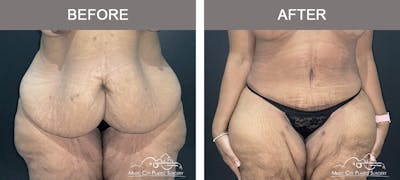 Belt Lipectomy Before & After Gallery - Patient 109443 - Image 1