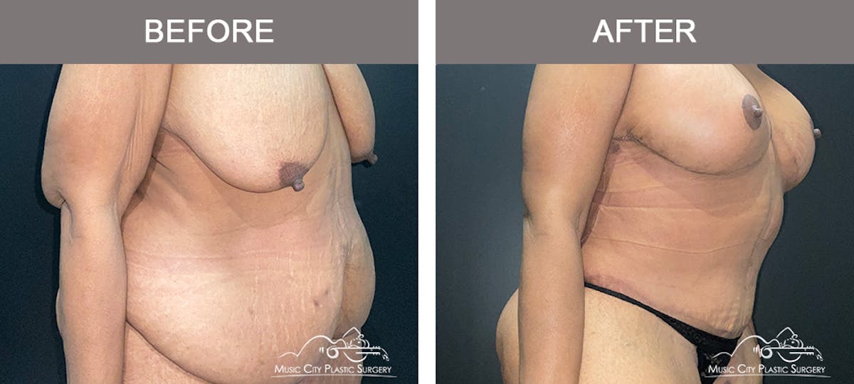 Belt Lipectomy Before & After Gallery - Patient 109443 - Image 2
