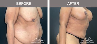 Belt Lipectomy Before & After Gallery - Patient 109443 - Image 2