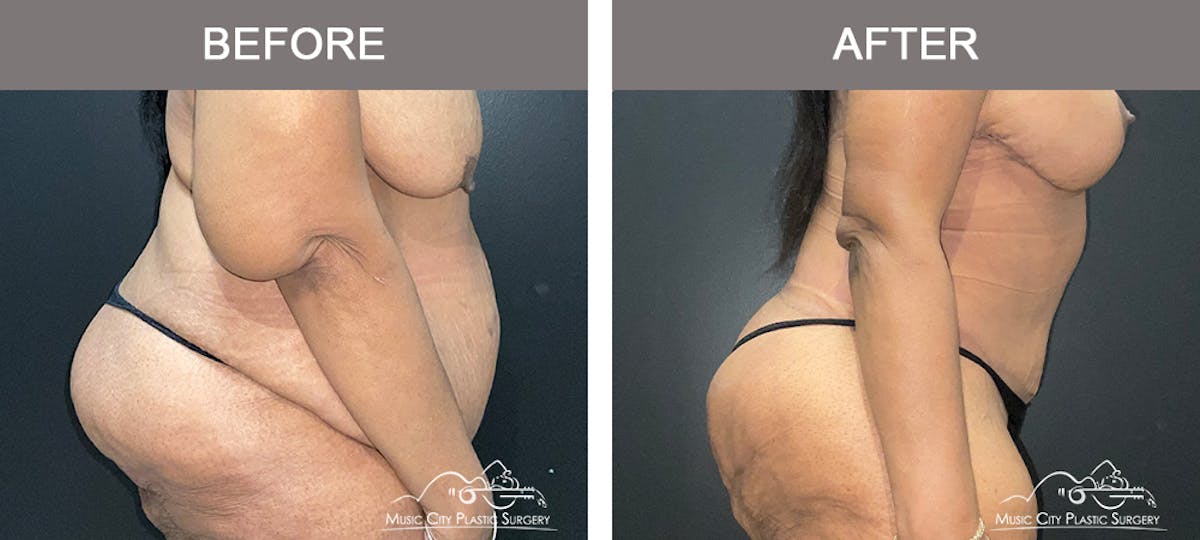 Belt Lipectomy Before & After Gallery - Patient 109443 - Image 3