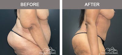 Belt Lipectomy Before & After Gallery - Patient 109443 - Image 3