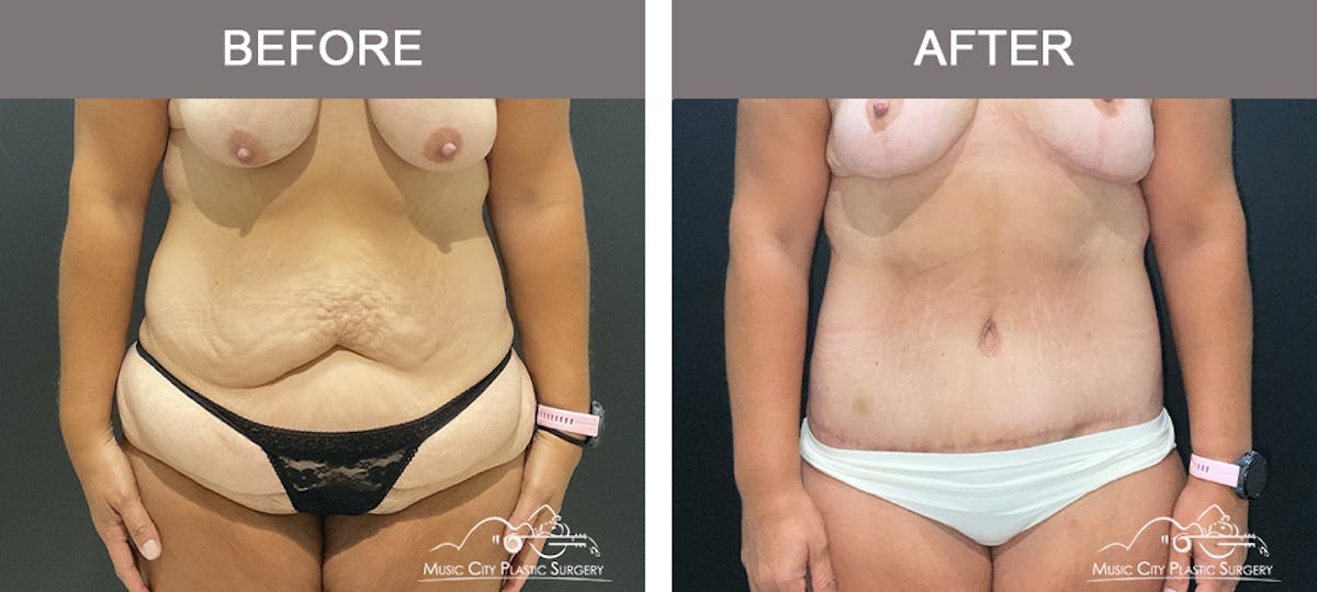 Belt Lipectomy Before & After Gallery - Patient 409941 - Image 1