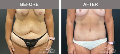 Belt Lipectomy Before & After Gallery - Patient 409941 - Image 1