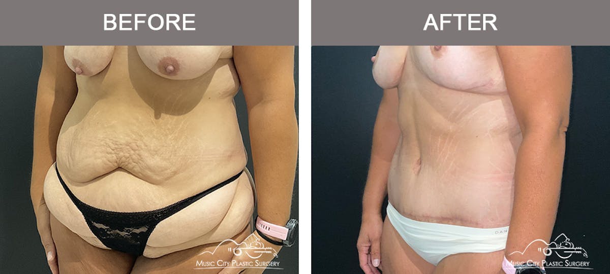 Belt Lipectomy Before & After Gallery - Patient 409941 - Image 2