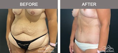 Belt Lipectomy Before & After Gallery - Patient 409941 - Image 2