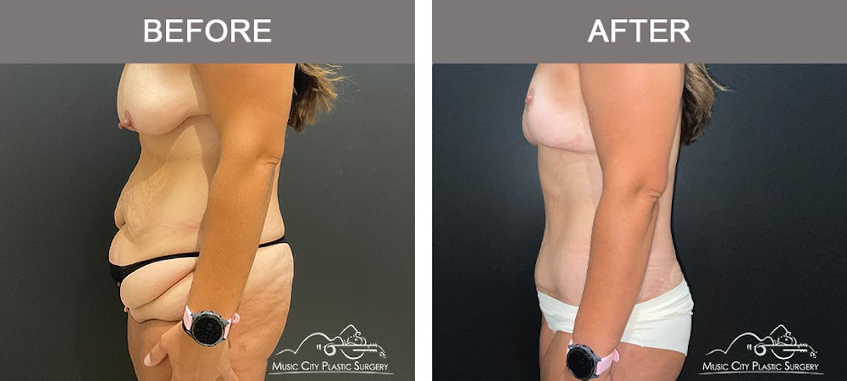 Belt Lipectomy Before & After Gallery - Patient 409941 - Image 3