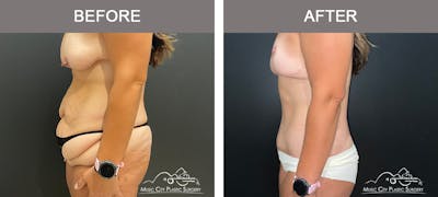 Belt Lipectomy Before & After Gallery - Patient 409941 - Image 3