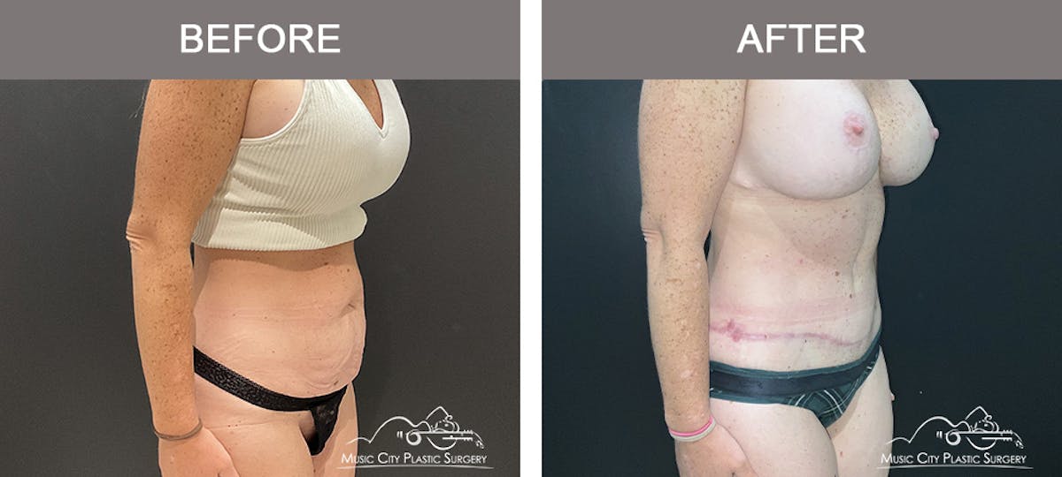 Belt Lipectomy Before & After Gallery - Patient 227605 - Image 2