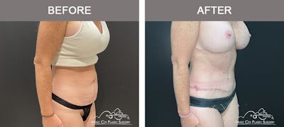 Belt Lipectomy Before & After Gallery - Patient 227605 - Image 2