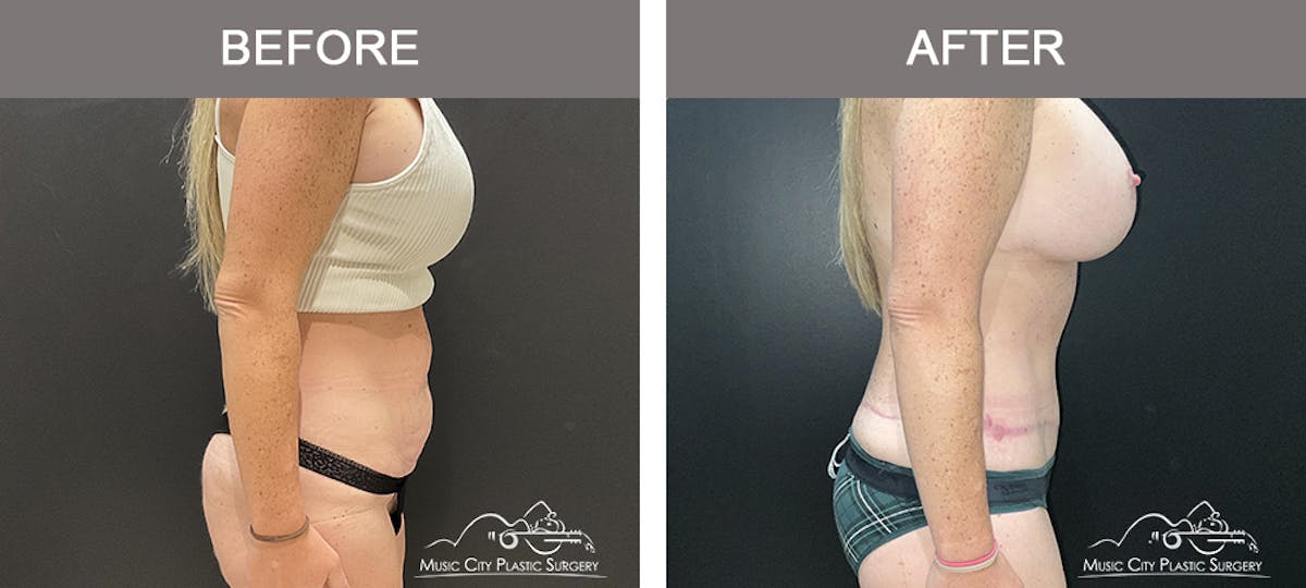 Belt Lipectomy Before & After Gallery - Patient 227605 - Image 3