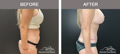 Belt Lipectomy Before & After Gallery - Patient 227605 - Image 3